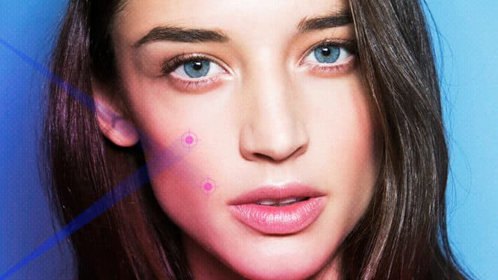 laser acne treatment