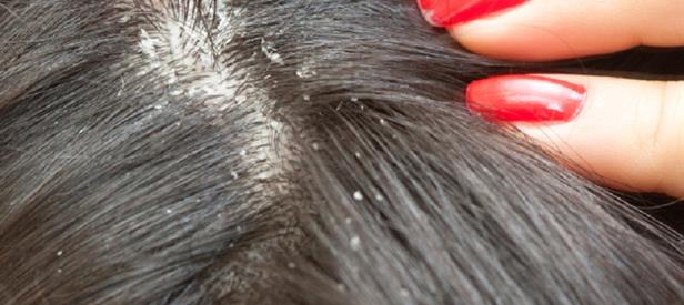 seborrheic-dermatitis