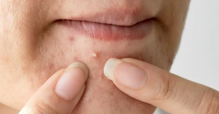 acne near mouth